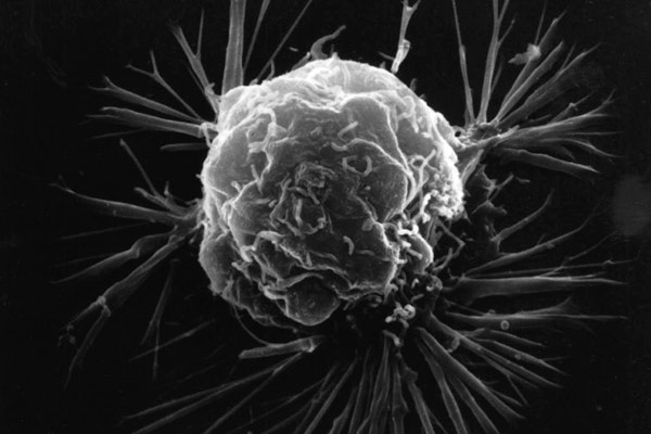 Ученые нашли средство от рака: лечение онкологических заболеваний станет возможным в скором времени