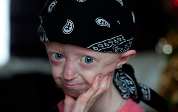 17-летняя британка умерла от преждевременного старения