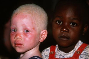 В Танзании шестилетнему альбиносу отрубили кисть руки