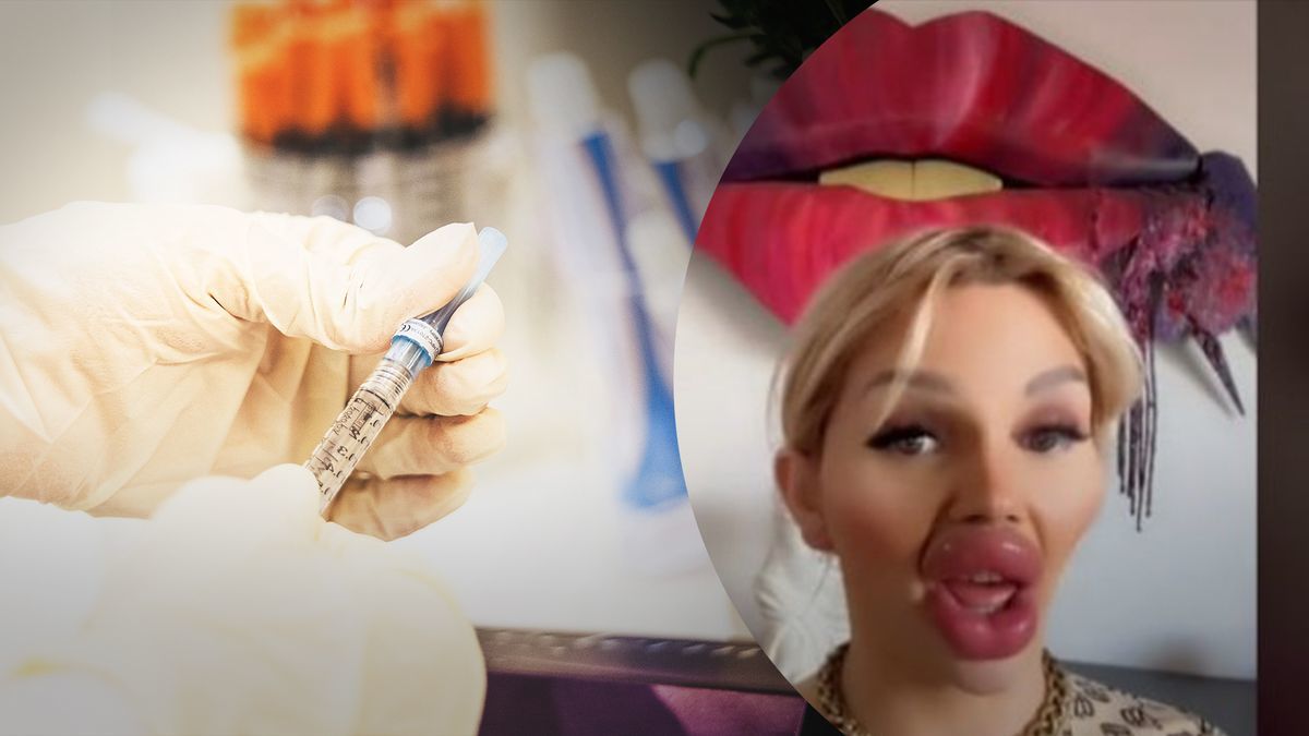 Женщина сделала губы на пол-лица, вколов рекордное количество филлеров: как она выглядит