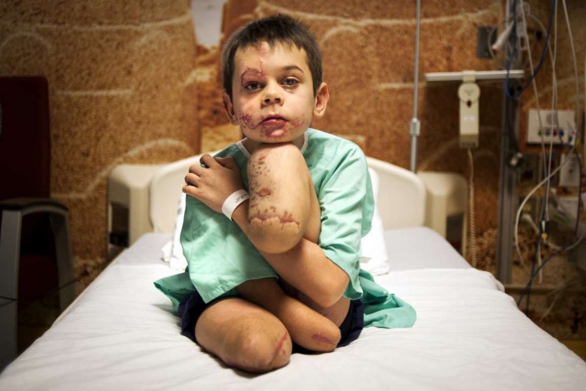 Фотография мальчика, подорвавшегося на Донбассе, победила в престижном международном конкурсе