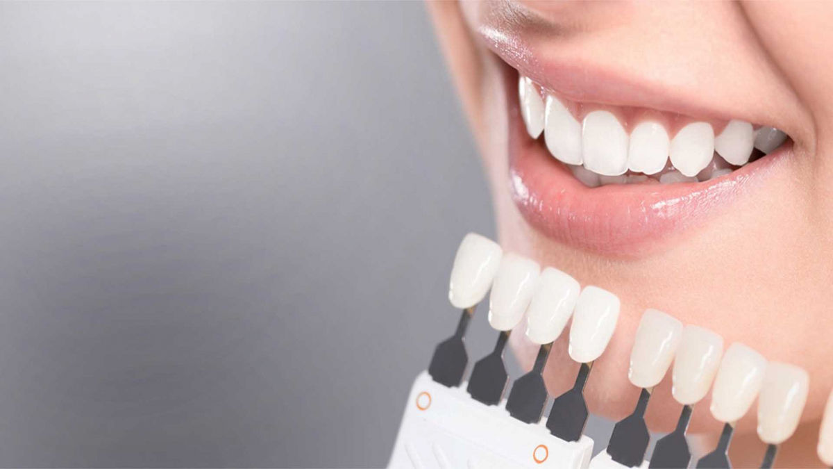 Плюсы и минусы отбеливания зубов: чем опасна процедура в домашних условиях