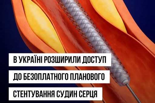 Важная новость для сердечников: плановое стентирование в Украине стало бесплатным