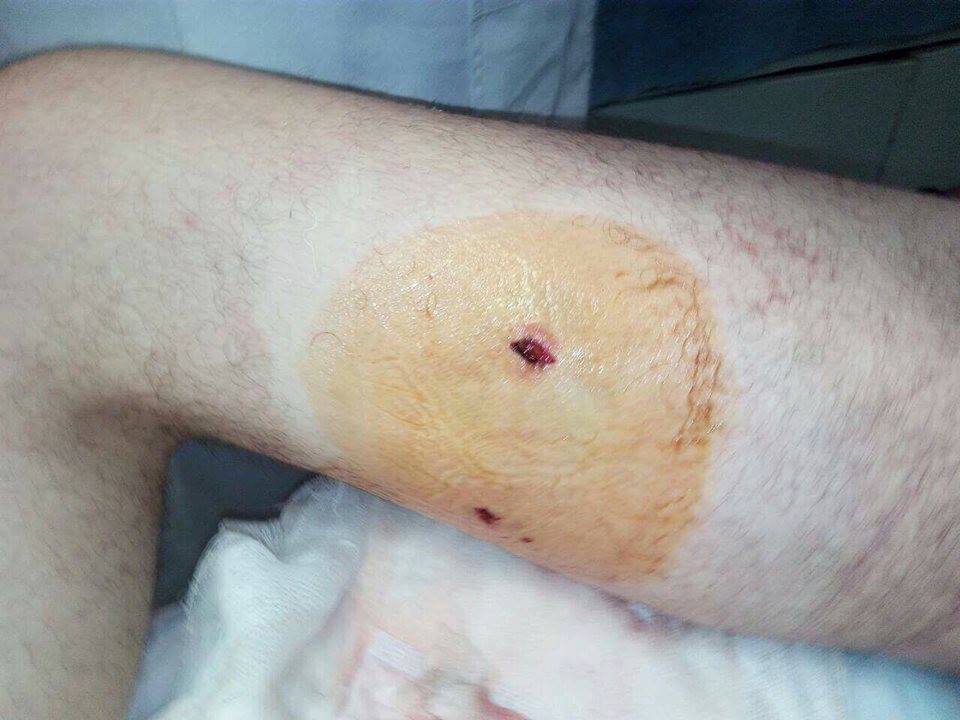 В Сети появился снимок "ужасного" ранения нардепа Дейдея - пользователи соцсетей высмеяли мемами поведение политика и то, что его везли в госпиталь на вертолете