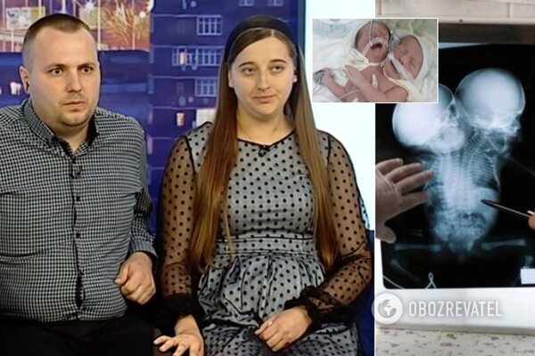 Появились фотографии сиамских близнецов из Черновцов: "Прожили всего 8 дней", - видео