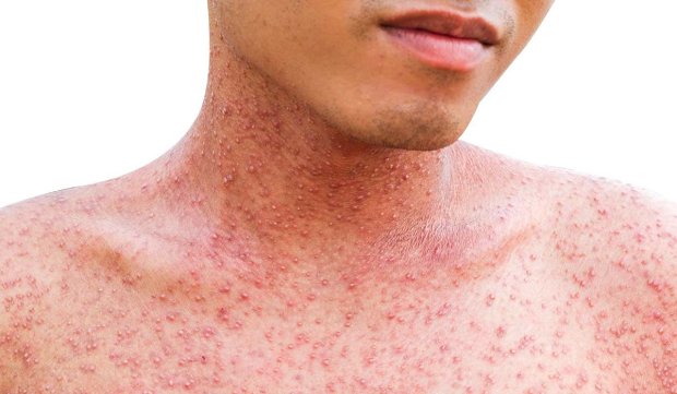 Украину атаковал опасный недуг: заражены более 50 тысяч граждан, в зоне риска и дети