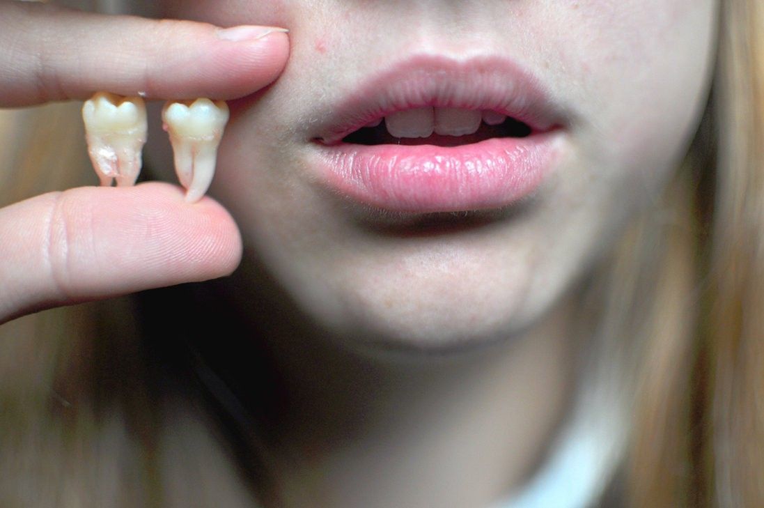 Зубы мудрости: чем они опасны, и все ли нужно удалять – ответ стоматолога