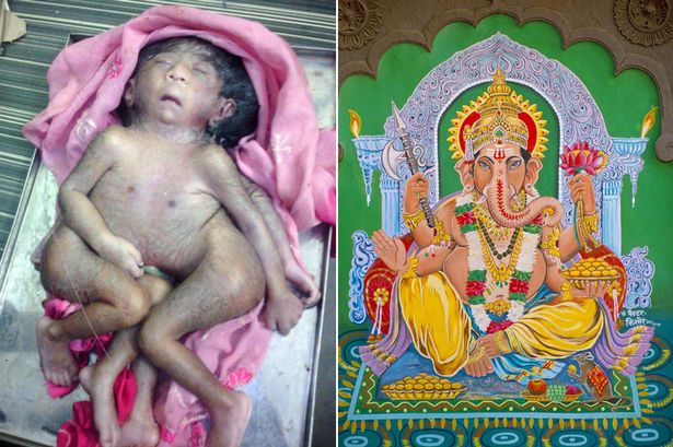 Mirror: в Индии родился ребенок с восемью конечностями