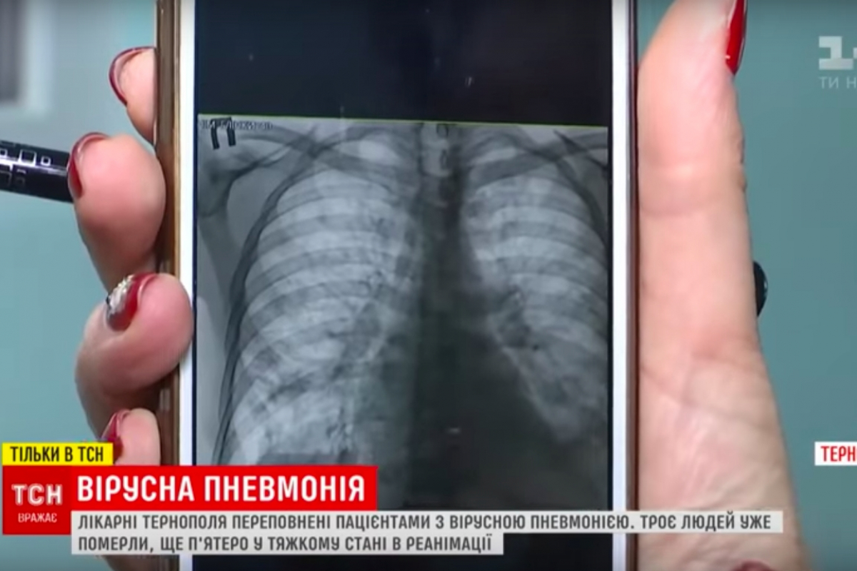 ​"Легкие сгорают", - в Тернополе и Житомире неизвестная агрессивная пневмония убивает людей, детали
