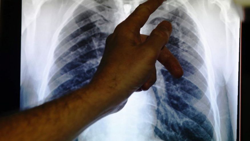 "ЛНР" на грани эпидемии туберкулеза: с начала года уровень смертности от страшного недуга вырос на 25 процентов