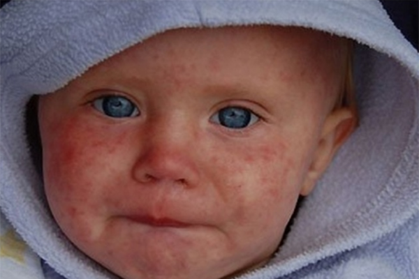 Спасет только вакцинация: в Киеве эпидемия кори